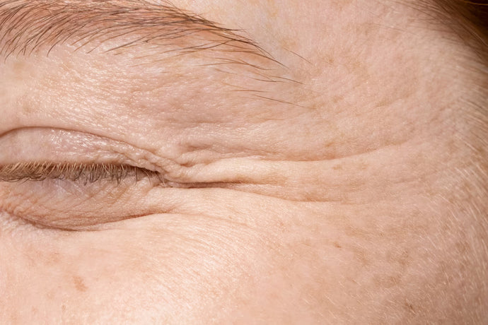 UNDEREYE BUMPS AND WRINKLES? HERE'S HOW TO TREAT THEM