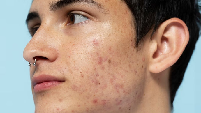HOW ACNE DIFFERS FROM SKIN TO SKIN